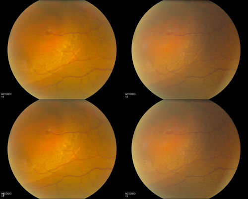Retinal Detachment with Retinal Tear
Patient comes in with complaints of floaters in the right eye. VA was 20/40 with no improvement. Fundus exam shows retinal detachment from 9-12 o'clock with hole at 10:30 posteriorly. Pneumatic Retinopexy was performed with C3F8 Gas bubble and laser around the retinal tear in the right eye. 
