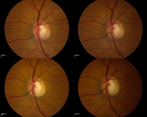 Notching of Optic Nerve Rim Inferiorly
Progression of glaucoma in the left eye. Past 3-years, developed a notch inferior to the optic disc in the left eye. 
