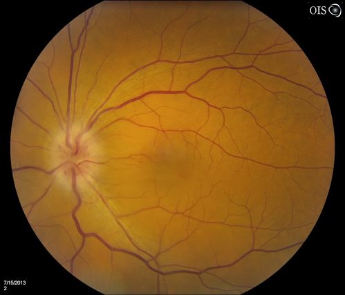 Optic Neuritis/Neuroretinitis
Pt. states lost some vision in his left eye last week, was seen by eye MD and referred for eval.  Also complains of pain in left eye with eye movement. VA was 20/400 in the left eye. Fundus photo and HD-OCT imaging show optic nerve swelling and fluid underneath the retina. Will consult with Neuro-Ophthalmologist for further evaluation.

