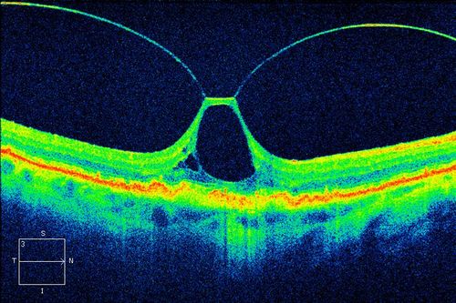 OCT Image of Tractional Maculopathy
