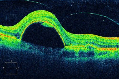 Large serous PED
63-year-old female with acute onset large retinal pigment epithelium detachment from age-related macular degeneration
Keywords: macular degeneration;pigment epithelial detachment,april2013
