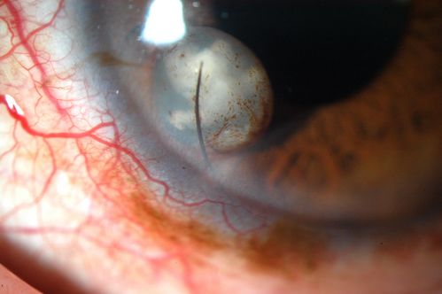 Cilia and Cement Intraocular Foreign Body
Construction worker jack-hammering 3 months prior to pictures.  Asymptomatic. 20/20 OU. Corneal wound seen superiorly (not in pictures)
Keywords: foreign body;intraocular;cilia;cement;projectile