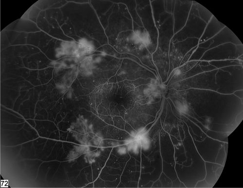 Angiogram of PDR
Keywords: Angiogram of PDR;september2012