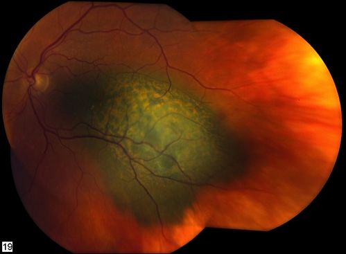 CHOROIDAL Melanoma
Keywords: MELINOMA;september2012