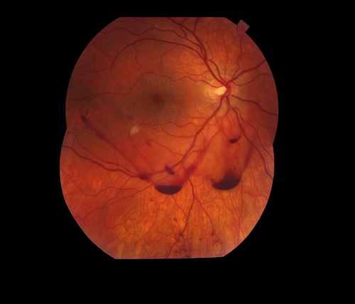 Traumatic Vitreous Hemorrhage - Firecracker in Face - Teenager
Sixteen year-old with traumatic vitreous hemorrhage following injury from firecracker exploding in his face.
Võtmesõnad: trauma