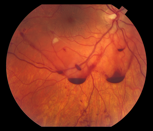 Traumatic Vitreous Hemorrhage - Firecracker in Face - Teenager
Sixteen year-old with traumatic vitreous hemorrhage following injury from firecracker exploding in his face.
Keywords: Trauma
