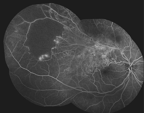 Diabetic Retimopathy with Peripherial Ischemia
30 year old woman with decreased vision right eye
Keywords: Ischemia