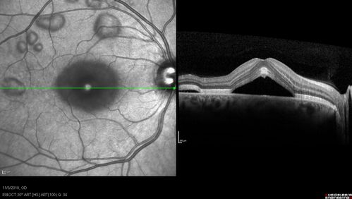 Acute Multifocal Vitelliform Exudative Maculopathy Right Eye At Presentation
OCT reveals submacular hyperreflective areas between RPE and photoreceptors with hyporeflective subretinal fluid

