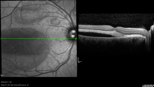 Acute Multifocal Vitelliform Exudative Maculopathy Right Eye At 3 Mo Follow Up
