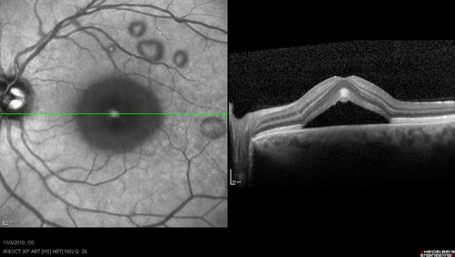 Acute Multifocal Vitelliform Exudative Maculopathy Left Eye At Presentation
OCT reveals submacular hyperreflective areas between RPE and photoreceptors with hyporeflective subretinal fluid

