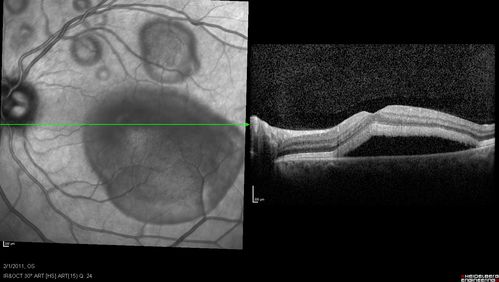 Acute Multifocal Vitelliform Exudative Maculopathy Left Eye At 1 Mo Follow Up
