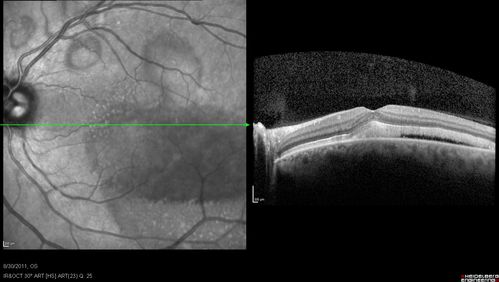 Acute Multifocal Vitelliform Exudative Maculopathy Left Eye At 3 Mo Follow Up
