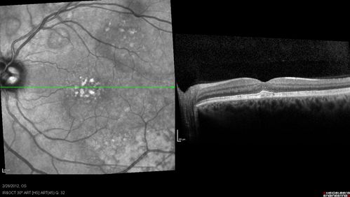 Acute Multifocal Vitelliform Exudative Maculopathy Left Eye At 6 Mo Follow Up
