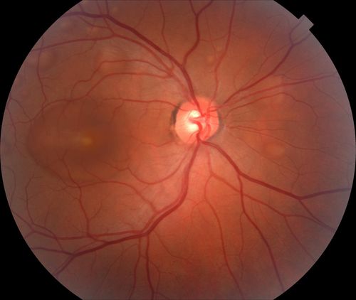 Acute Multifocal Vitelliform Exudative Maculopathy Left Eye
41 yr old male with decreased central vision 10 days OU.  Vision at presentation was 20/20, 20/40

