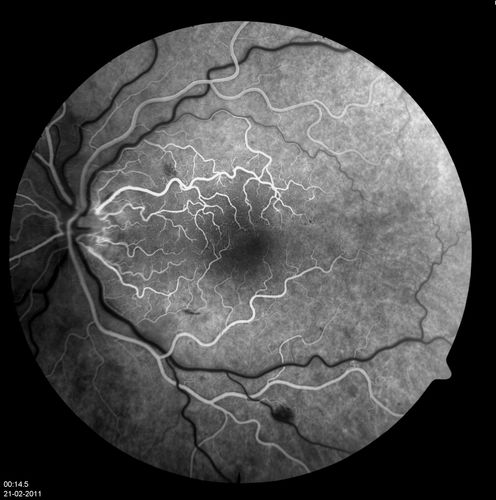 14.5 seconds
Corresponding FA for Cilioretinal artery occlusion with early venous stasis retinopathy 
Keywords: november2012