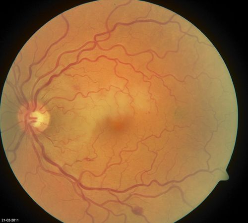 Cilioretinal artery occlusion
Cilioretinal artery occlusion with early venous stasis retinopathy
Keywords: Cilioretinal artery occlusion;venous stasis retinopathy