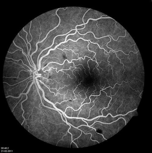 48.2 seconds
Corresponding FA for Cilioretinal artery occlusion with early venous stasis retinopathy 
