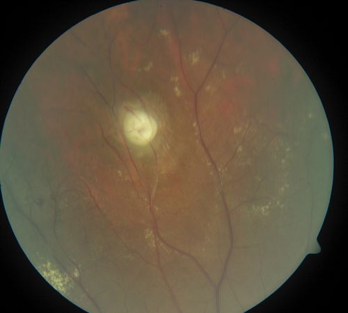 periphery 1. od 
quiescient/infarcted macroaneurysm
Palabras clave: coats disease;exudative retinitis;retinal telangiectasis;leber multiple miliary aneurysm disease
