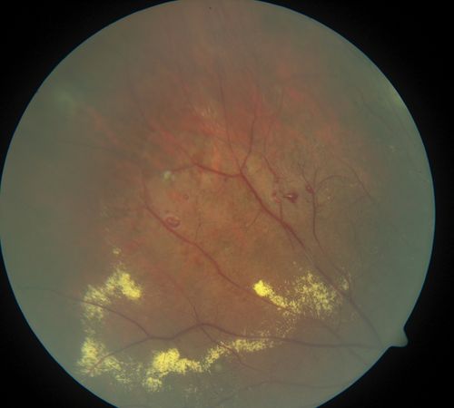 periphery 2. od
leaking miliary aneurysms
