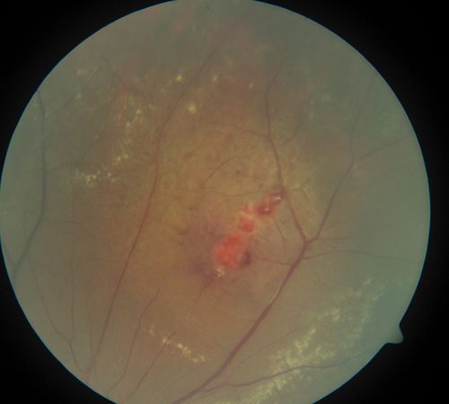 periphery 3. od
leaking miliary aneurysms
