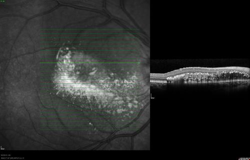 oct superior macula 1. od
