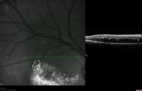 oct superior macula 2. od
