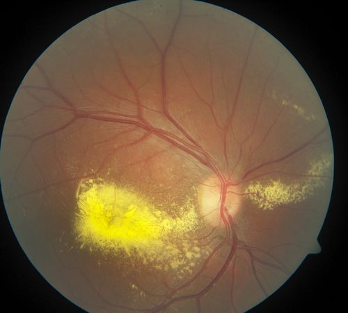 macula. od
coalescing exudates 
Keywords: coats disease;exudative retinitis;retinal telangiectasis;leber multiple miliary aneurysm disease