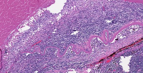 Phacoantigenic Reaction
Picture shows a Left eye enucleation with H&E staining. 

Anterior capsule of lens is broken with evidence of granulomatous inflammation. 
Keywords: Phacoantigenic;december2012