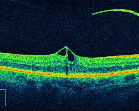 Macular Pucker
OCT scan of MP 
Keywords: Vitreous Macular Traction;VMT;Macular Pucker;MP