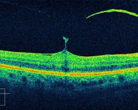Macular Pucker
OCT scan of MP 
Keywords: Vitreous Macular Traction;VMT;Macular Pucker;MP