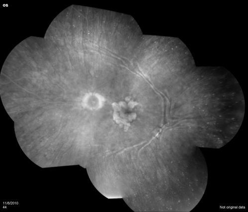 Choroidal Folds secondarly to Dry ARMD
Choroidal Folds and Dry ARMD in OS
Keywords: CF;Choroidal Folds;ARMD