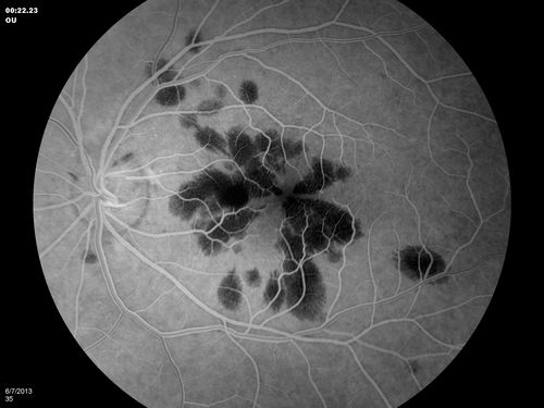 Unilateral Hemorrhagic Retinopathy
Unilateral Hemorrhagic Retinopathy
Keywords: Unilateral Hemorrhagic Retinopathy