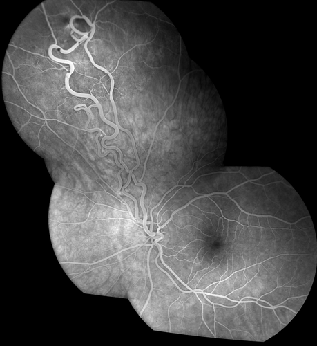 AVM
FA of AVM in OS of a 48 yr old female.
Keywords: AVM;Arteriol Venous Malformation