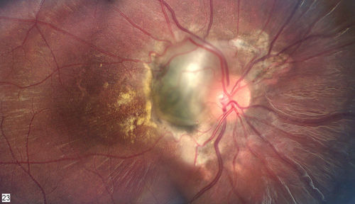 Idiopathic CNVM in 6 year old girl
CNVM in OD of a 6 yr old girl
Keywords: CNVM;january2013