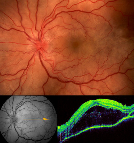Vogtâ€“Koyanagiâ€“Harada Syndrome OS
43 yr old Italian Male with VKH in both eyes.
Keywords: Vogtâ€“Koyanagiâ€“Harada Syndrome, VKH;january2013