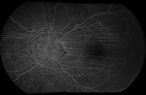 Choroidal Folds
Montage OS of Choroidal Folds
Keywords: CF;Choroidal Folds