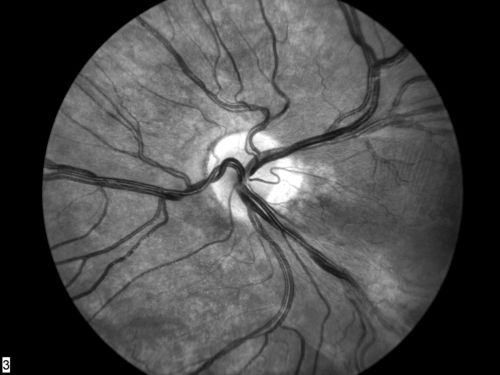 FEVR in OS of a 14 yr old girl
Mots-clés: FEVR;Familial Exudative Vitreoretinopathy