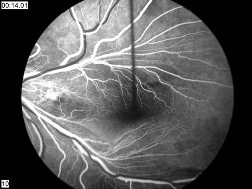 FEVR FA Transit
FEVR in OS of a 14 yr old girl
Keywords: FEVR;Familial Exudative Vitreoretinopathy