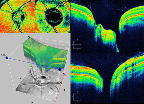Optic Pit OCT
OCT Scan of an Optic Pit in OS of a 40 yr old male
Keywords: Optic Pit,january2013