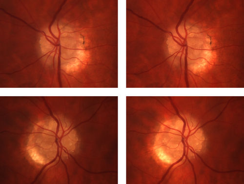 OU Stereo Pair Optic Disc Drusen
Text book example of OU optic discs with drusen in stereo.
Keywords: Optic Disc Drusen,april2013