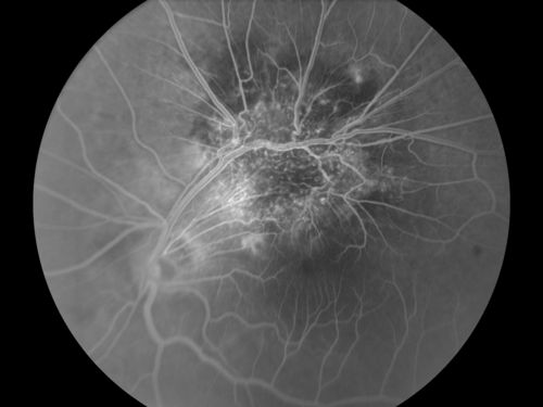 Haramotoma with ERM
Haramotoma with an ERM in the OS of a middle aged man
Keywords: Haramotoma;ERM;Retinal Tumor