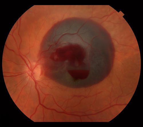 Macroaneurysm FP
Macroaneurysm with Subretinal Hemorrhage and ME in OS of an Elderly Female
Keywords: Macroaneurysm;Subretinal Hemorrhage;Macular Edema;ME;MA;Hemo;january2013