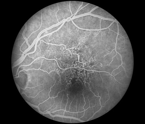 telangiectasia
20/20 pt with blurry area in va
Keywords: telangiectasia;vascular abnormality;march2014