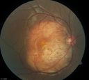 retinagallery.jpg