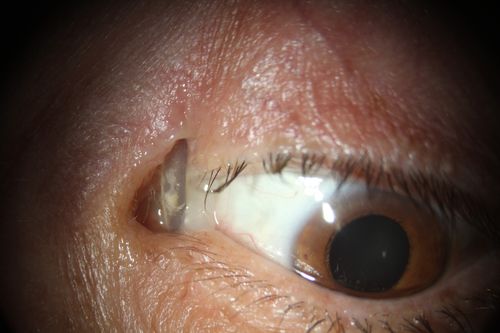 Silicon implant is seen inserted in to the superior lid skin
another view of the implant intruded in the lid skin
Keywords: post-retinal detachment, buckle extrusion