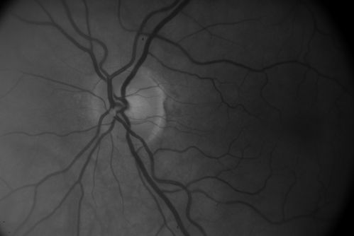 Embolic CRAO B&W
