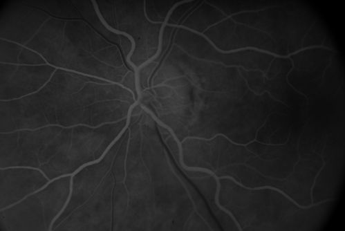 Embolic CRAO Early
