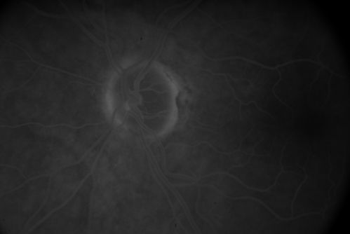 Embolic CRAO Late
