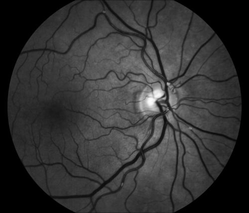 Red Free of Hollenhorst Plaque
Red free fundus photo of patient with multiple hollenhorst plaque
Võtmesõnad: Hollenhorst Plaque