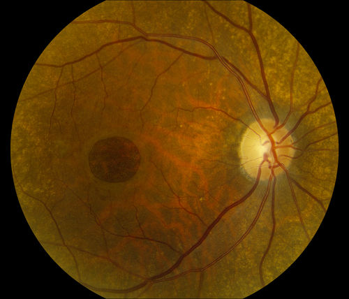 Full Thickness Macular Hole
Full Thickness Macular Hole
Keywords: macular hole, May2014